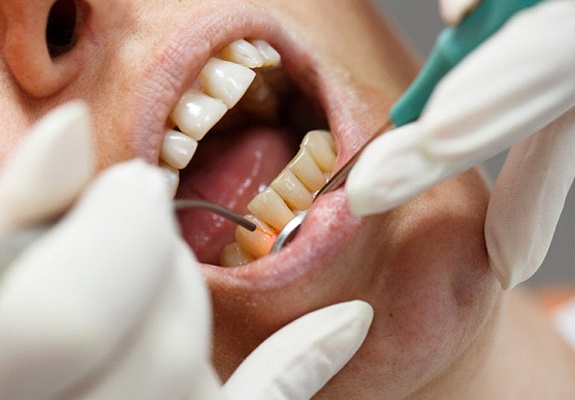 dentist using a soft tissue laser on patient