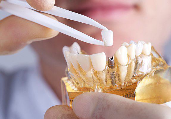 A dentist placing a crown onto a dental implant model