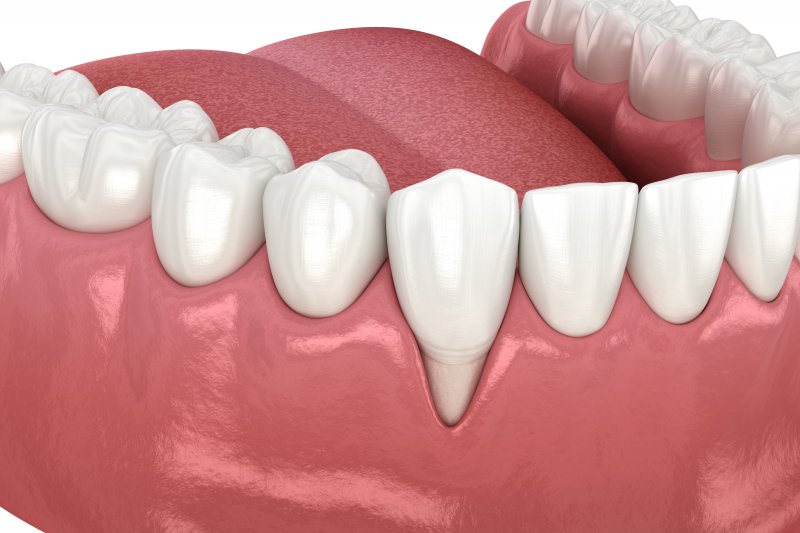 A 3D illustration of receding gums